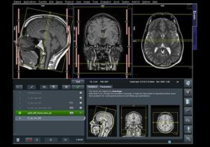 Beelden van MRI scan hoofd en hersenen