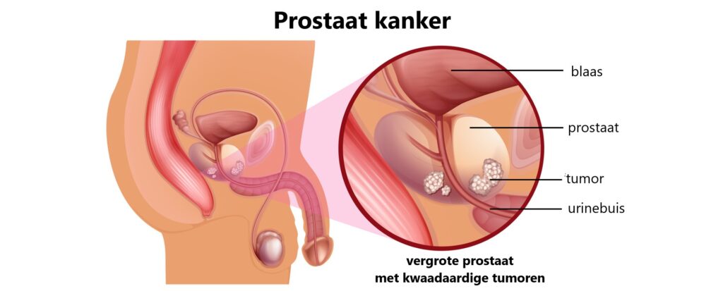 Prostaat kanker