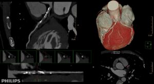 CT scan angiografie hart afbeelding